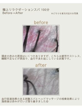 カピリナ(KaPilina)/頭皮のBefore→After