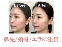 ラプリ 札幌ル・トロワ店/隆鼻+輪郭矯正40分 1回