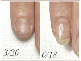 【自爪育成】わずか3ヶ月で...