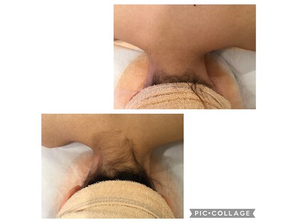 エピラックス(epilax)の写真