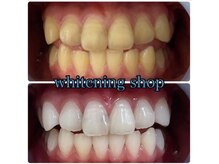 ホワイトニングショップ 大阪玉造店/Before&After美白ホワイトニング