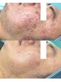リメイククリニカルビューティー(Remake clinical beauty)&nbsp;ニキビ、ニキビジ跡、でこぼこに！