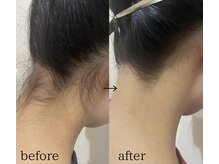 スパイリーア(Spiraea)/脱毛BeforeAfter