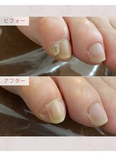 ふっとけ庵/副爪ケア
