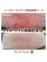 レアルステイト 金沢店/実績多数◎あらゆる肌悩みに対応