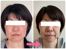 小顔矯正サロン ブルーム/立体的なお顔へ