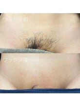 カナウ(KANAU)/VIO脱毛（30代前半男性）