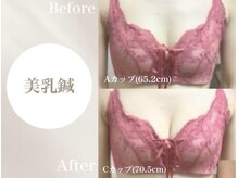 Onはり灸サロン/バストUP美乳鍼before→after