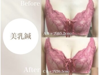 Onはり灸サロン/バストUP美乳鍼before→after