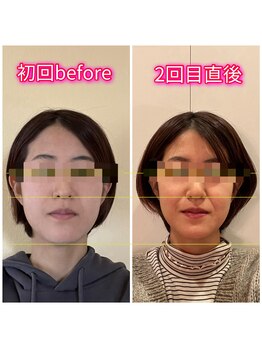 ハーボプラス(THE HEARBO plus)/面長が気になっています