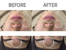 ライム 錦糸町(LIME)/ハーブピーリング｜ニキビケア