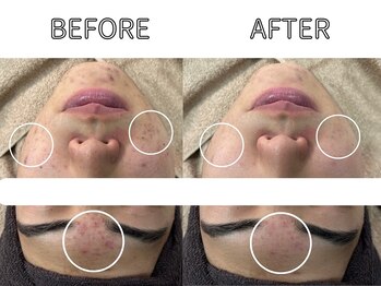 ライム 錦糸町(LIME)/ハーブピーリング|ニキビケア