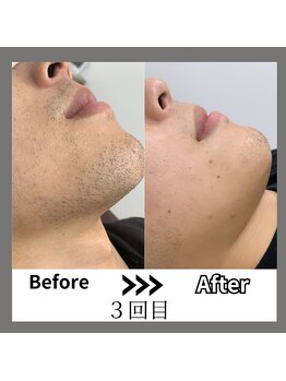 ミライキング(mirai king)/ビフォーアフター