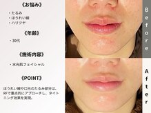 ルディラ 新宿店/水光肌フェイシャル