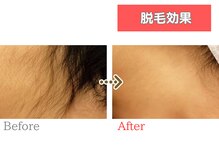 HGB 東山公園駅前店/女性｜10代｜学生