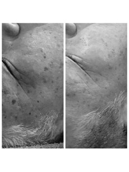 ディープブルー(Deep Blue)/プラペンデュアル施術