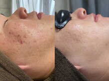 モルフォム(Morphome)/IPL光フェイシャル