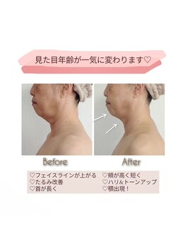 ミードット(me.)/フェイスラインを引き上げる☆