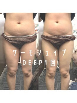 リラクゼーションサロン ラキ(laki)/サーモシェイプDEEP/痩身