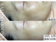 サロン ヒゴロ(SALON HIGORO)/シミケア