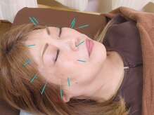 マック鍼灸院(MAC鍼灸院)/お顔のむくみが気になる方に