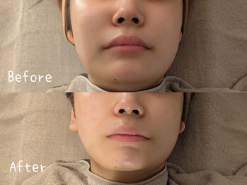 サロン ド モミカル(salon de momikaru)/毛穴洗浄