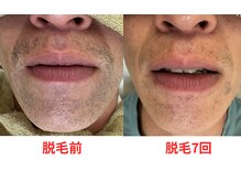 ビビ/ヒゲ脱毛/メンズ脱毛/髭脱毛