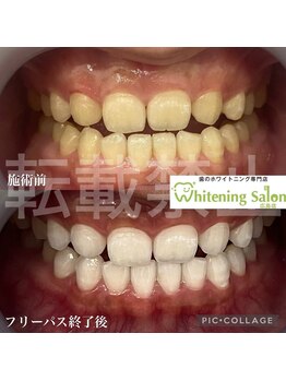ホワイトニングサロン 広島店/【ホワイトニング施術例】