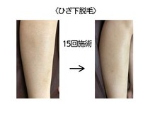 サロン ド クラール(salon de curar)の雰囲気（【膝下脱毛】ムダ毛の濃い方でも大丈夫！今から始めて夏スッキリ）