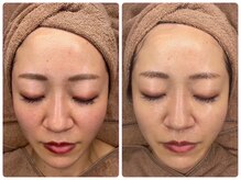 ホワイトアクア 浜松店(WHITE AQUA)/ララピール/ニキビケア