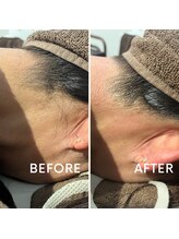 グリン(grin)/ワックス脱毛(3)