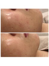 レ ベージュ(L’Beige)/リアボーテ肌質改善フェイシャル