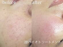 エーアール(ar)/毛穴エクストラクション