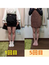 ヨサパーク アカーシャ(YOSA PARK AKASHA)/５回の施術でスッキリ。