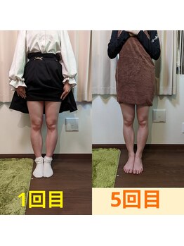 ヨサパーク アカーシャ(YOSA PARK AKASHA)/５回の施術でスッキリ。