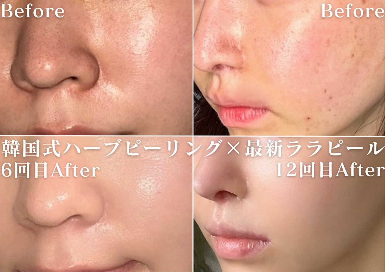 ハーブピーリング image.php?id=2518309&p=shopn&s