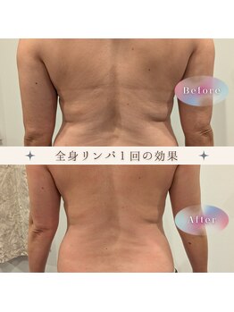 ルメリア(Lumelia)/全身リンパ１回ビフォーアフター