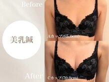 Onはり灸サロン/バストUP美乳鍼before→after