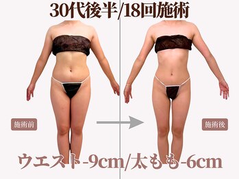 ベモーレ 谷町九丁目 上本町の写真/"私史上最高の姿"を実現！花嫁ボディメイクで二の腕・背中丸ごと全身痩身￥9900！圧倒的ドレス映えを実現◎