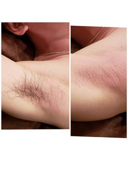 ラピス(Lapis)/ワキ脱毛