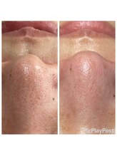 リフロ(Rifuro)/韓国式3D毛穴洗浄