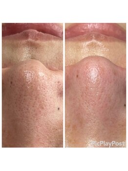 リフロ(Rifuro)/韓国式3D毛穴洗浄