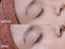 アルムボーテ 代官山 恵比寿(ARUIM Beaute)/シェービングビフォーアフター