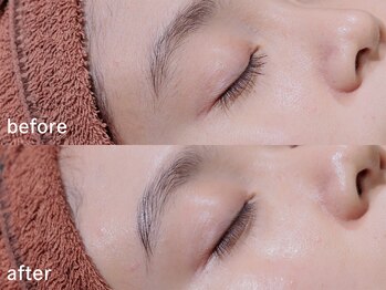 アルムボーテ 代官山 恵比寿(ARUIM Beaute)/シェービングビフォーアフター