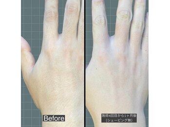 アレッド 大阪店(ared.)/脱毛！