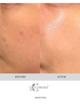 メルシー(merci)/速攻白雪肌に*スノーピール