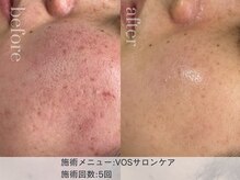 リエイト(Lieto)/VOSサロンケア