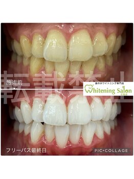 ホワイトニングサロン 広島店/【ホワイトニング施術例】