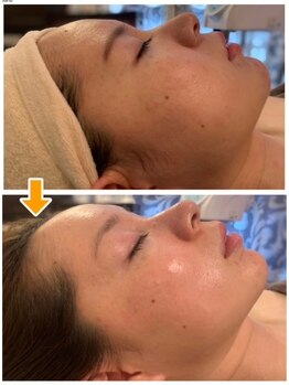 アンプリール(emplir)の写真/「最近老けた？」と言わせない！ほうれい線・たるみを徹底ケア。キュッと引き締まった、若々しいお顔へ