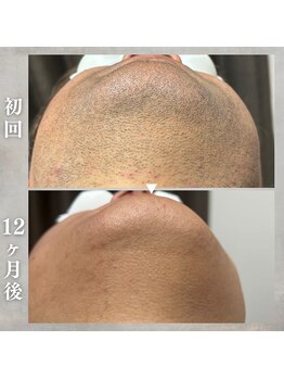 シック 南風原店(Chic)/40代　ヒゲ脱毛　1年後の経過